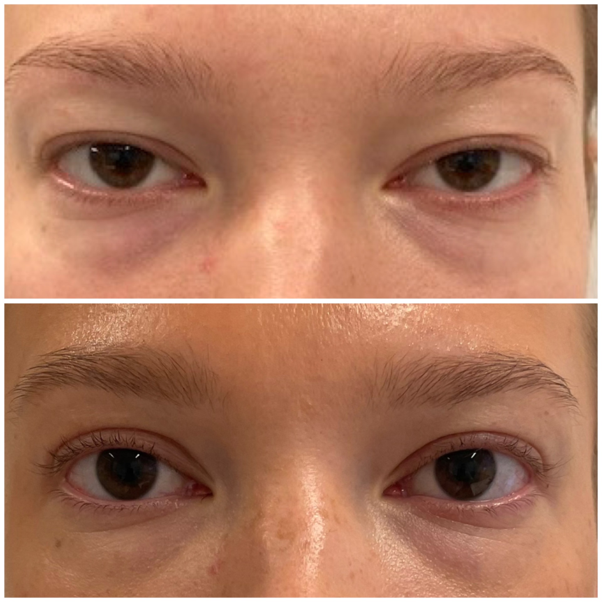 Blepharoplasty