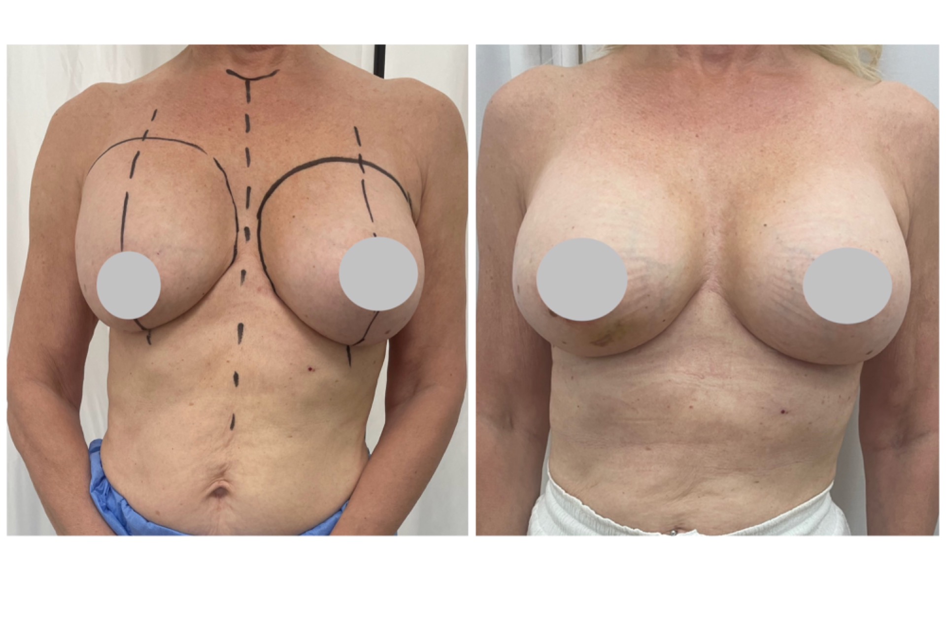 Korkealla olevan implantin korjaus