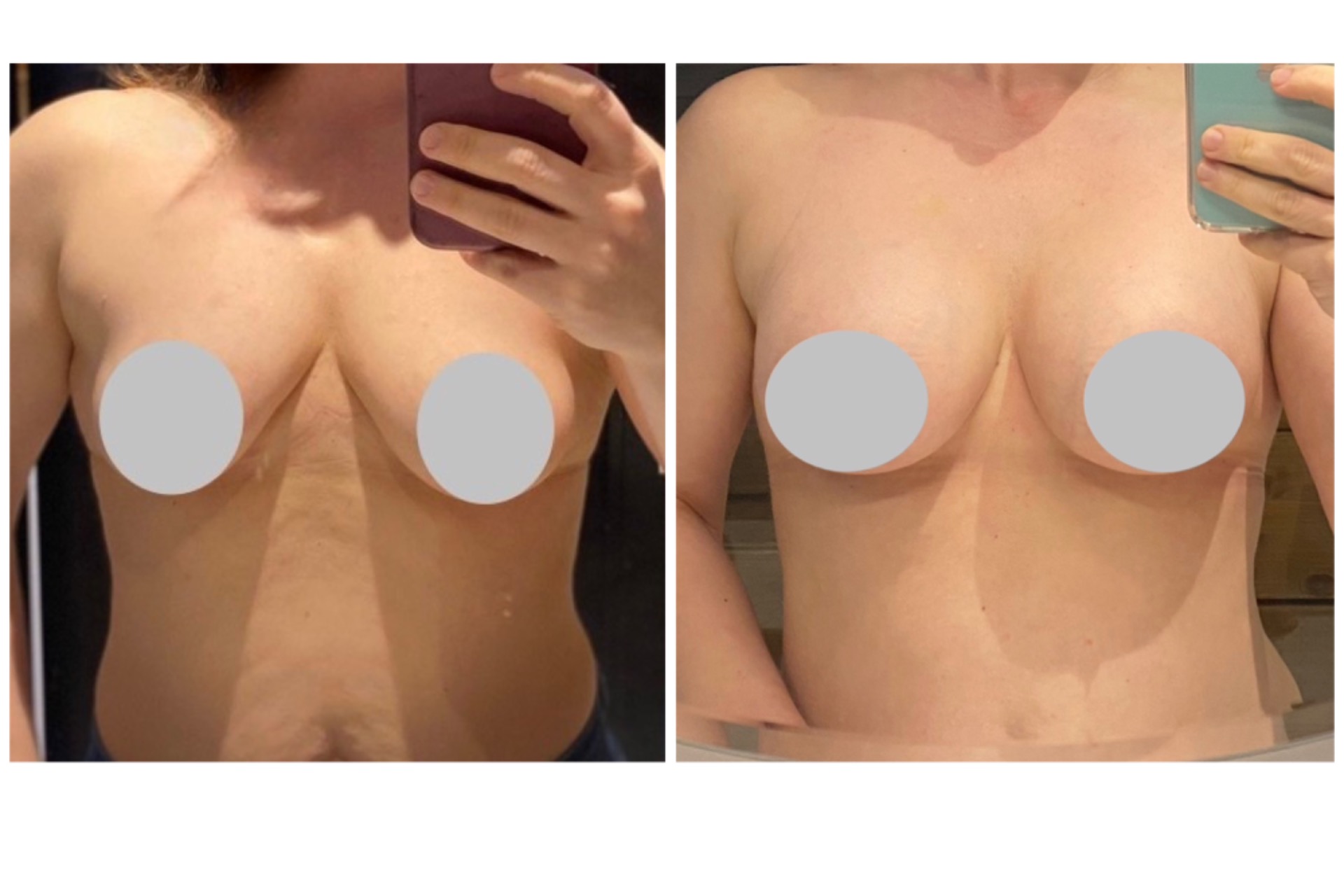Aigmentation with 320 cc implants