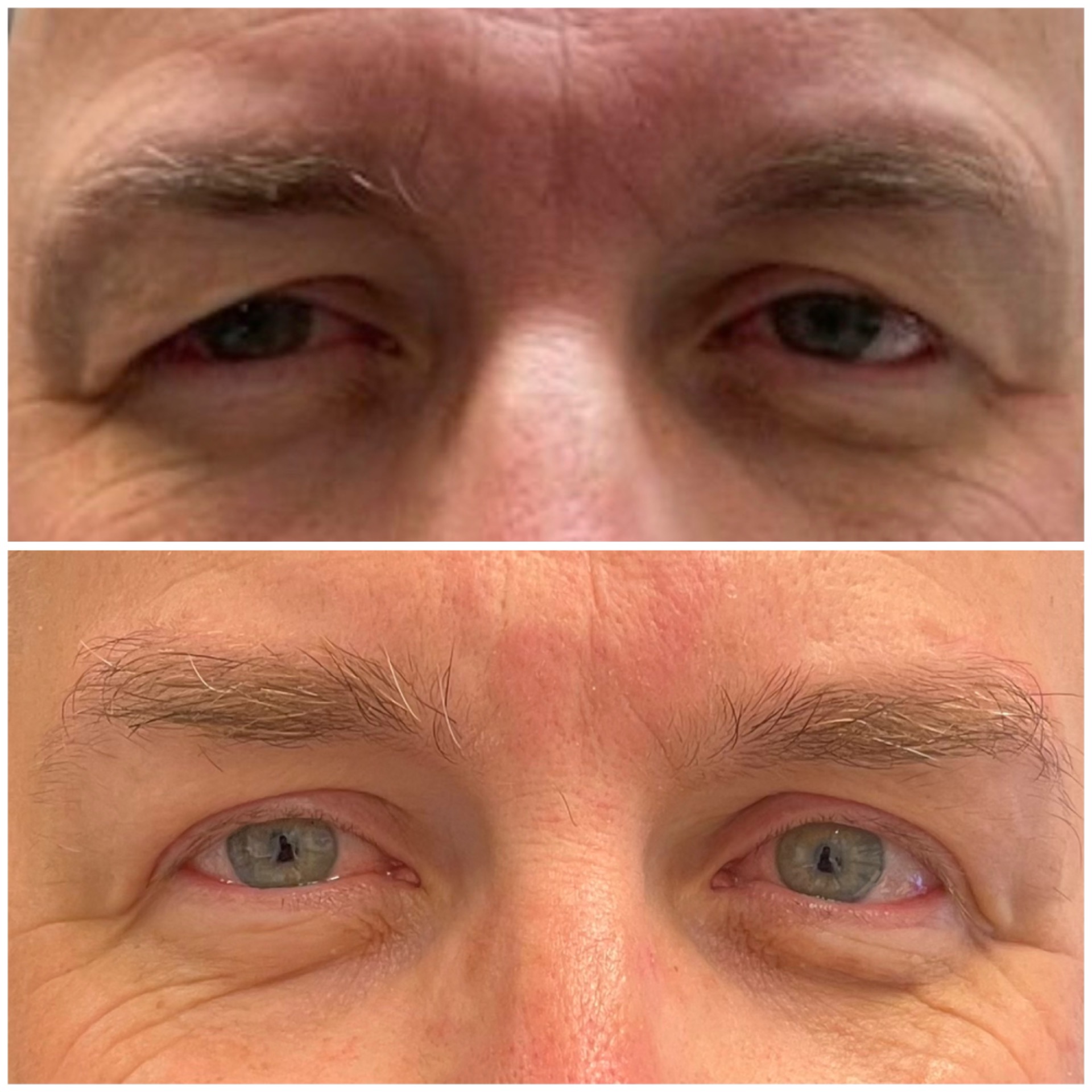 Blepharoplasty and brow lift