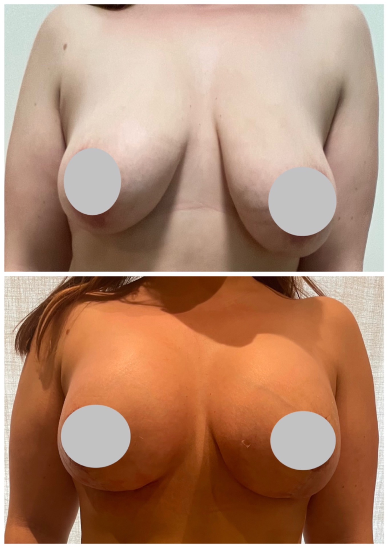 Augmentation mastopexy with 360cc implant