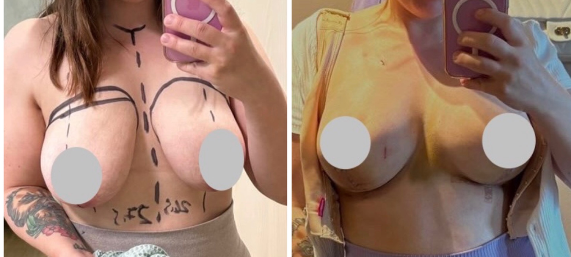 Rintojen suurennus implanteilla yhdistettynä kohotukseen