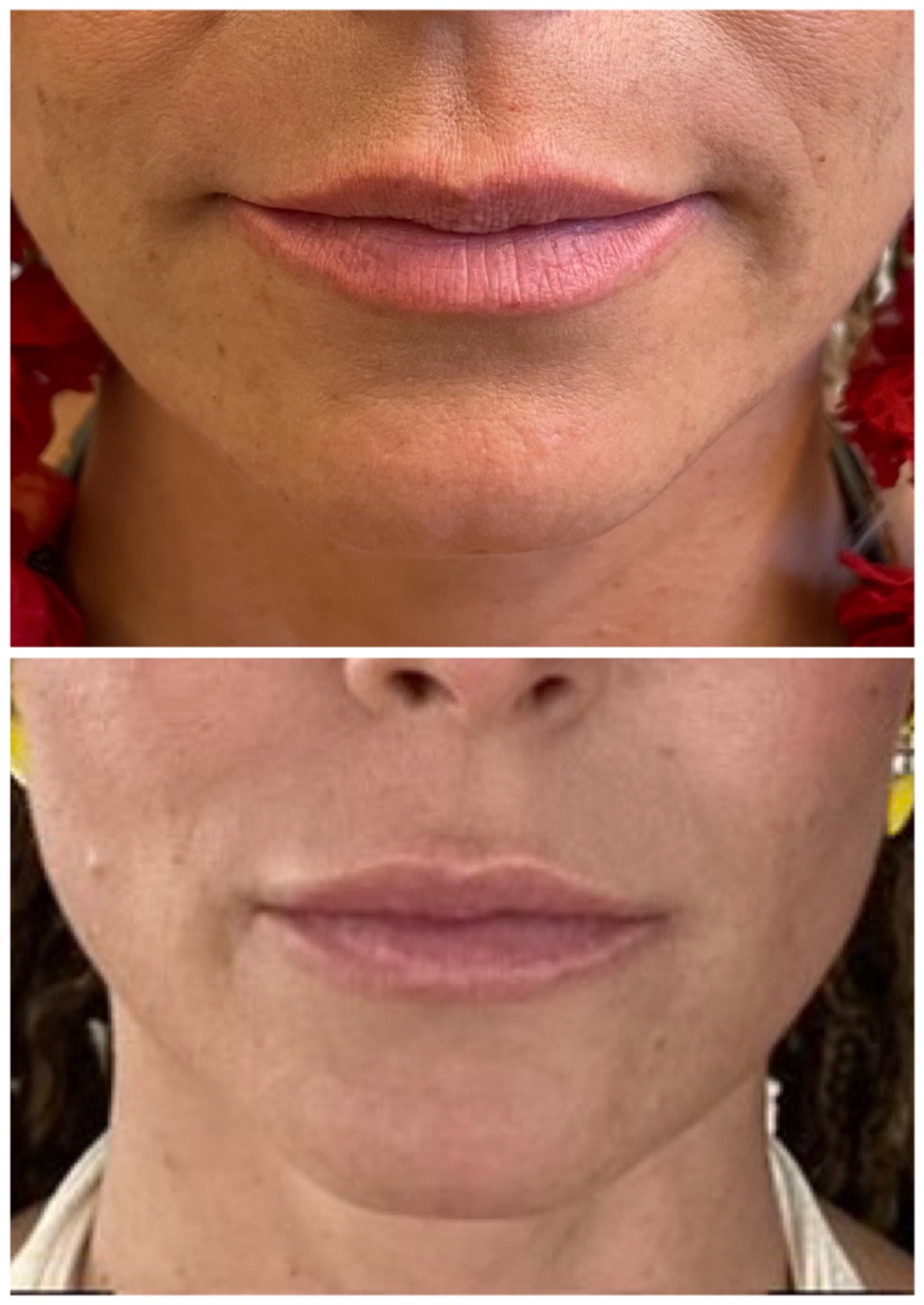 Lip filler treatment