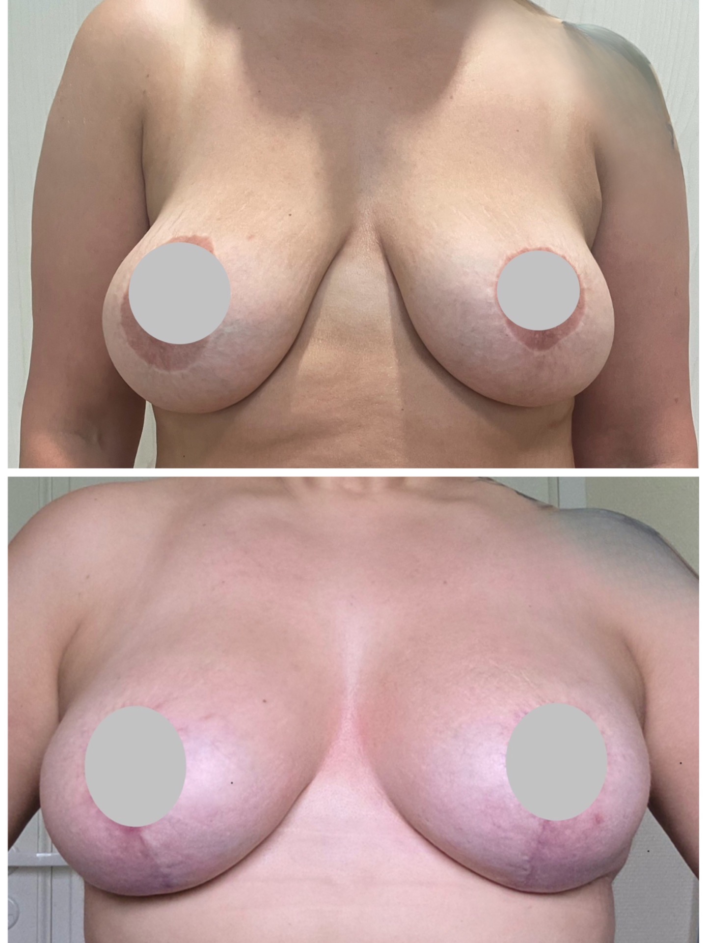 Implant exchange to low weight implants and mastopexy