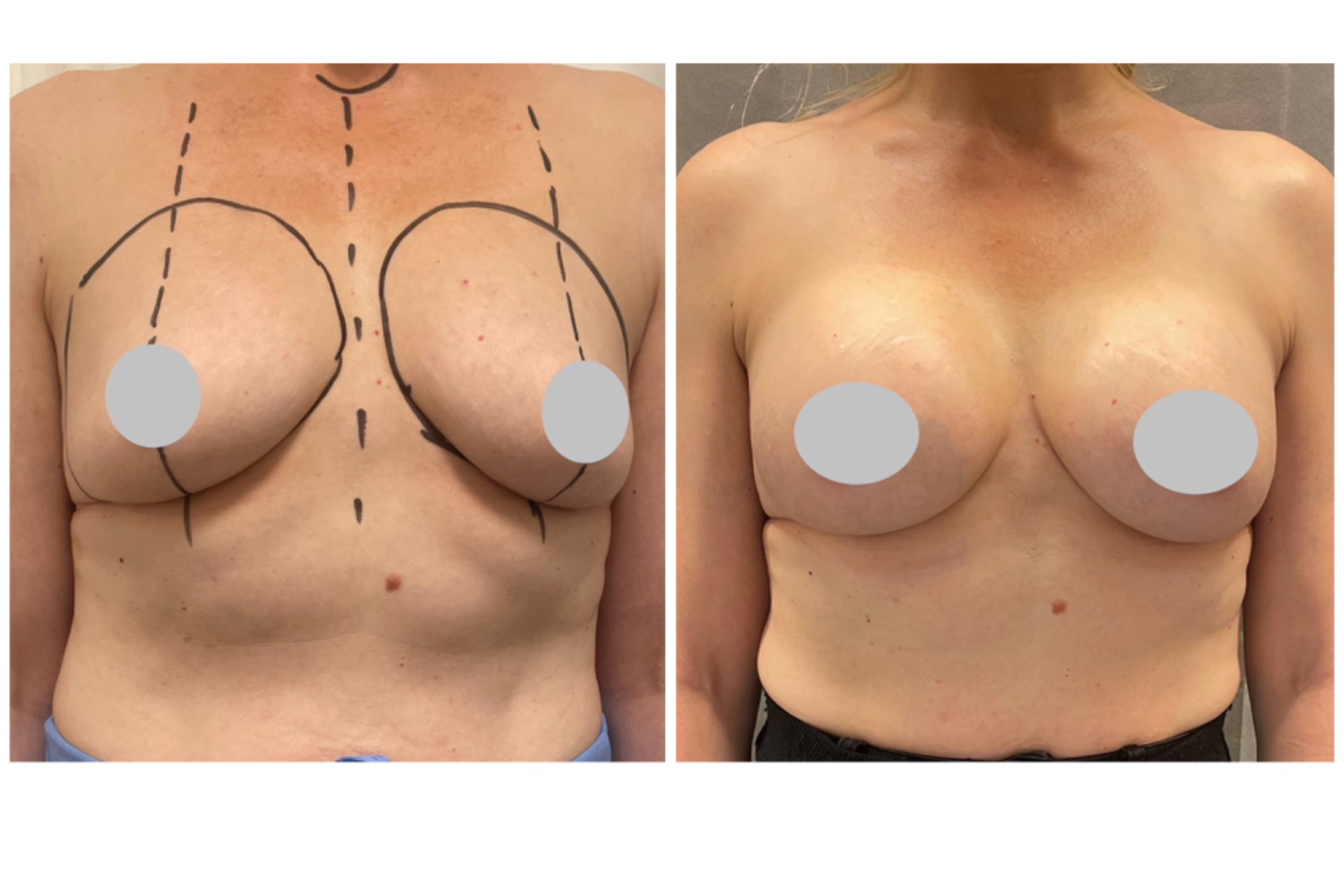 300cc implantit lihaksen päällä