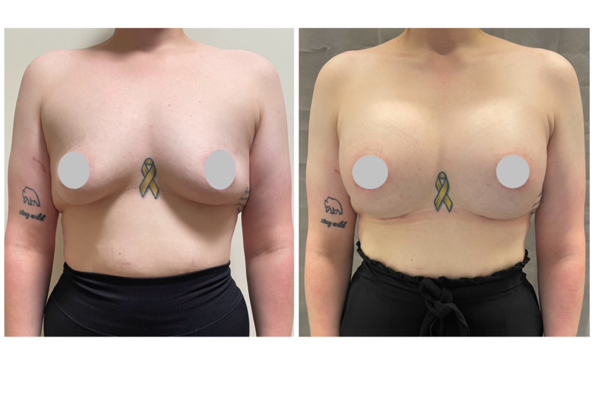 495cc Light weight implants (B-lite)