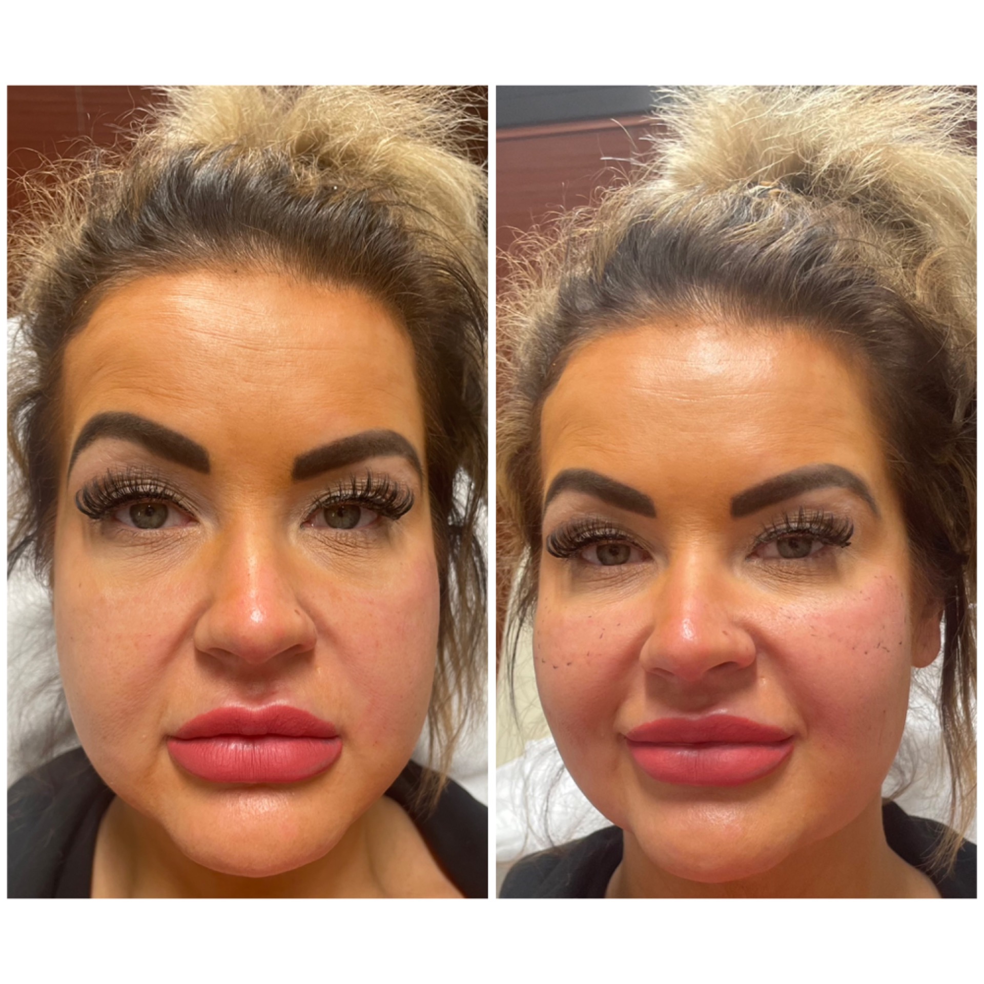 Chin filler treatment