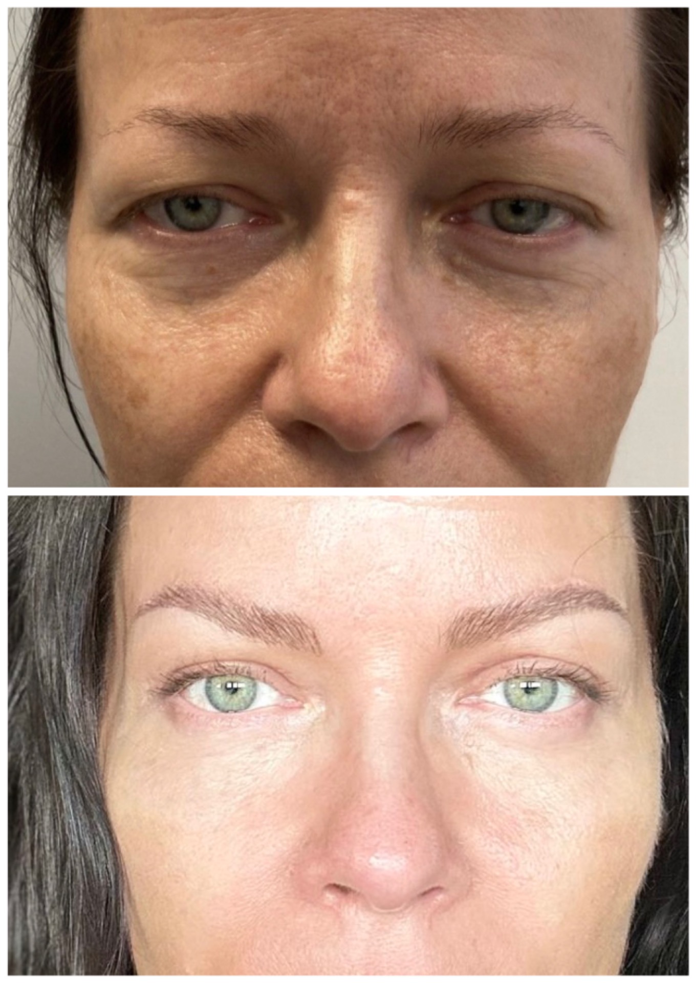 Blepharoplasty and browlift