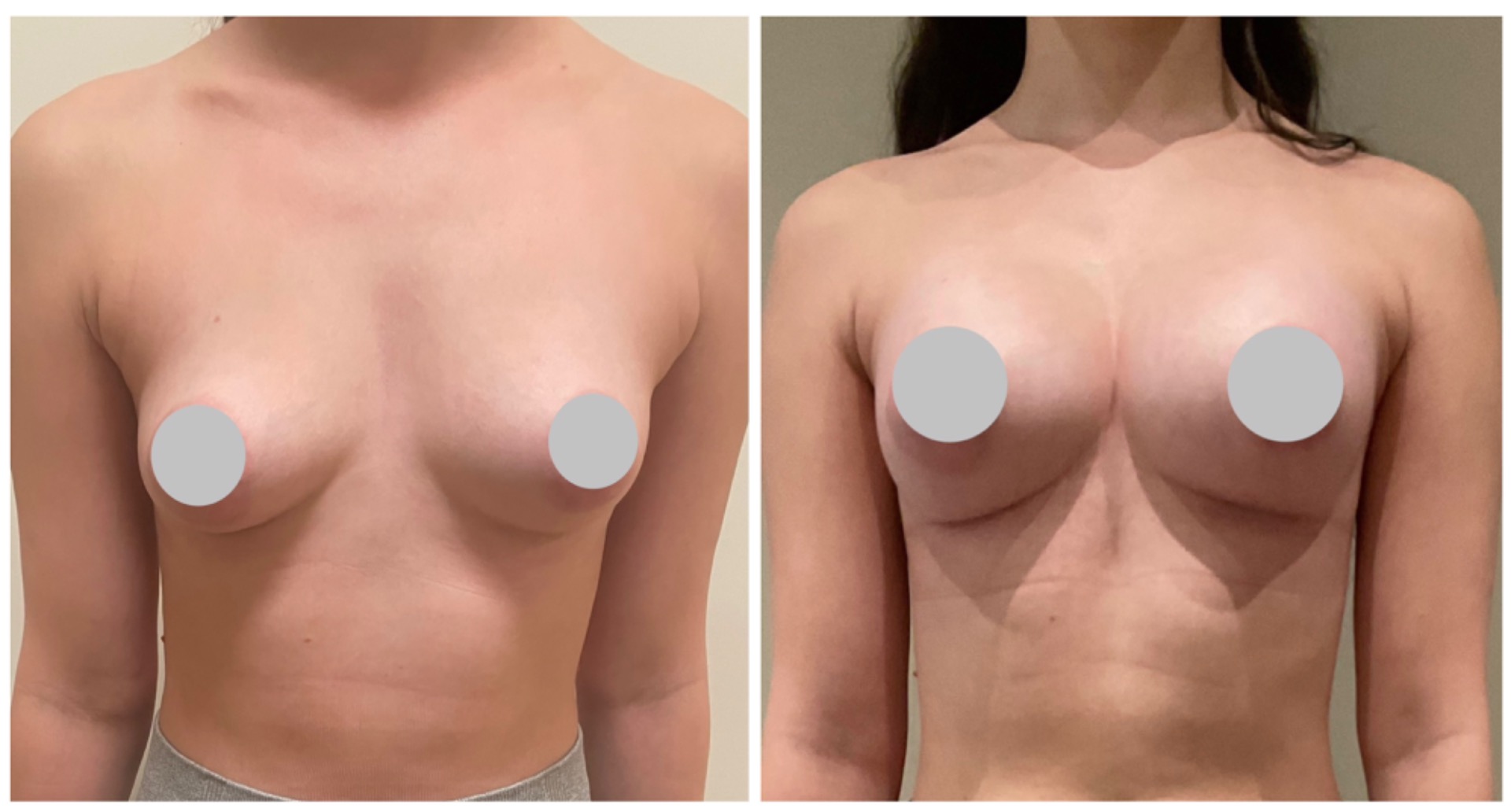 Augmentation with 250cc implants