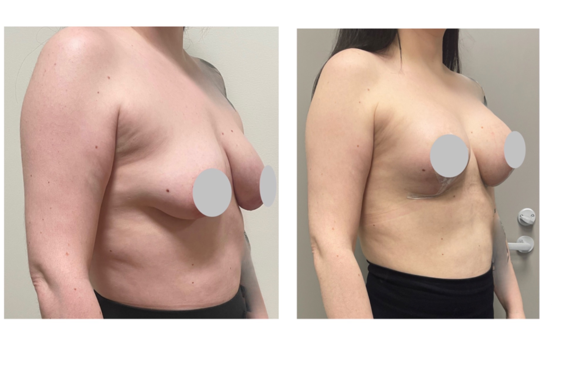 Augmentation-mastopexy