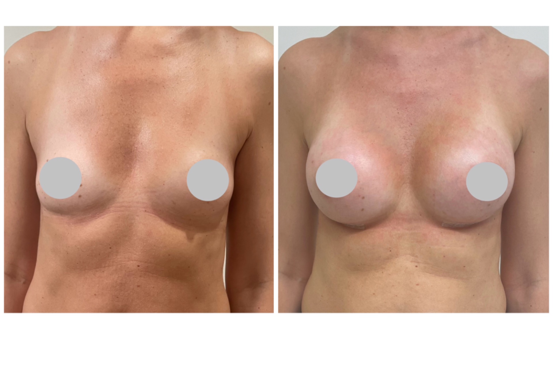Breast augmentation 275cc implants
