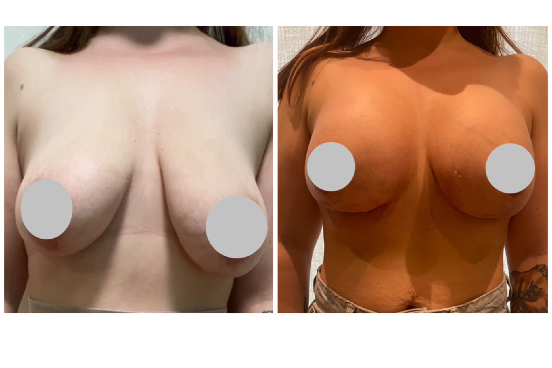Augmentation mastopexy with 360cc implant