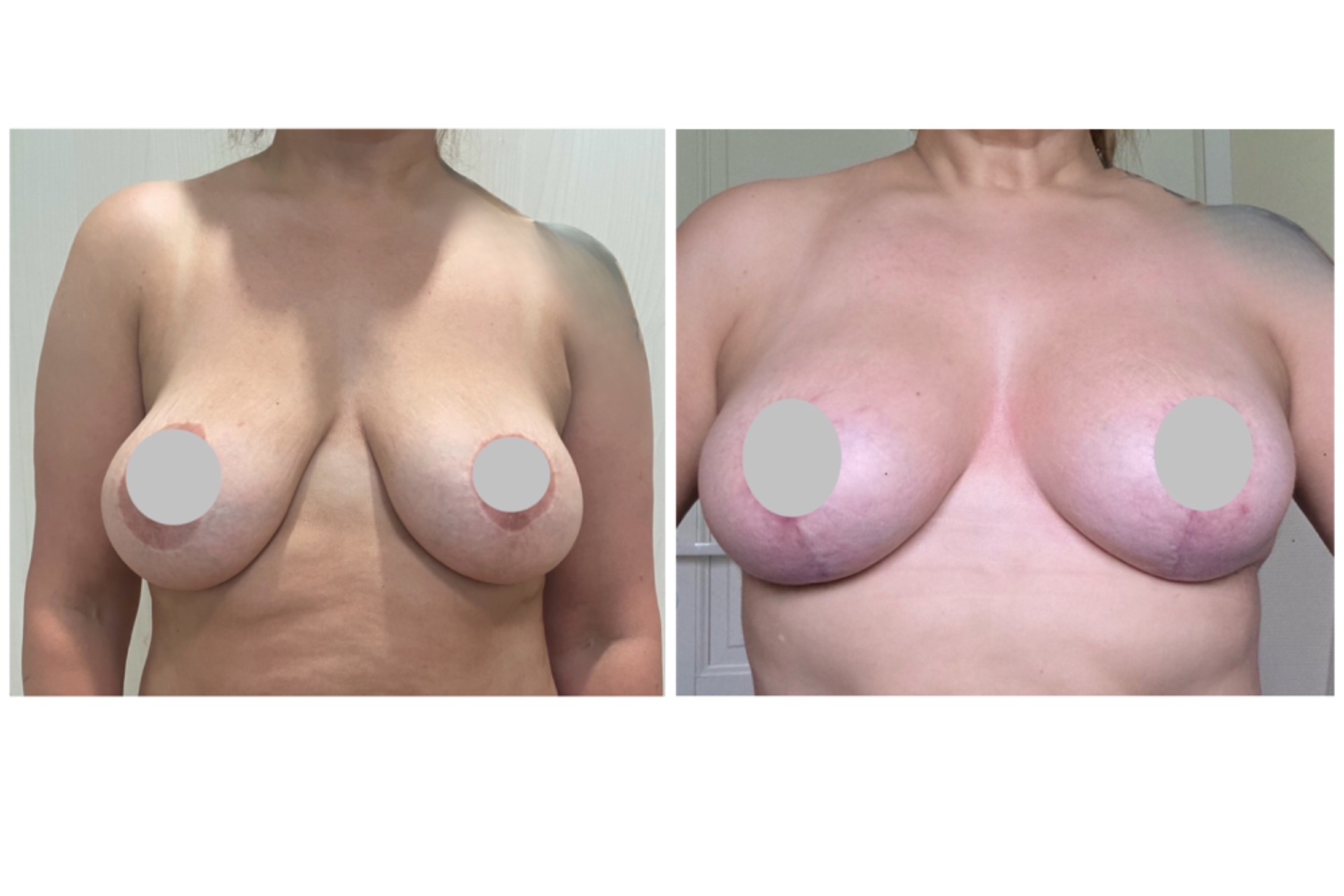 Vanhojen implanttien vaihto kevytimplantteihin ja kohotus