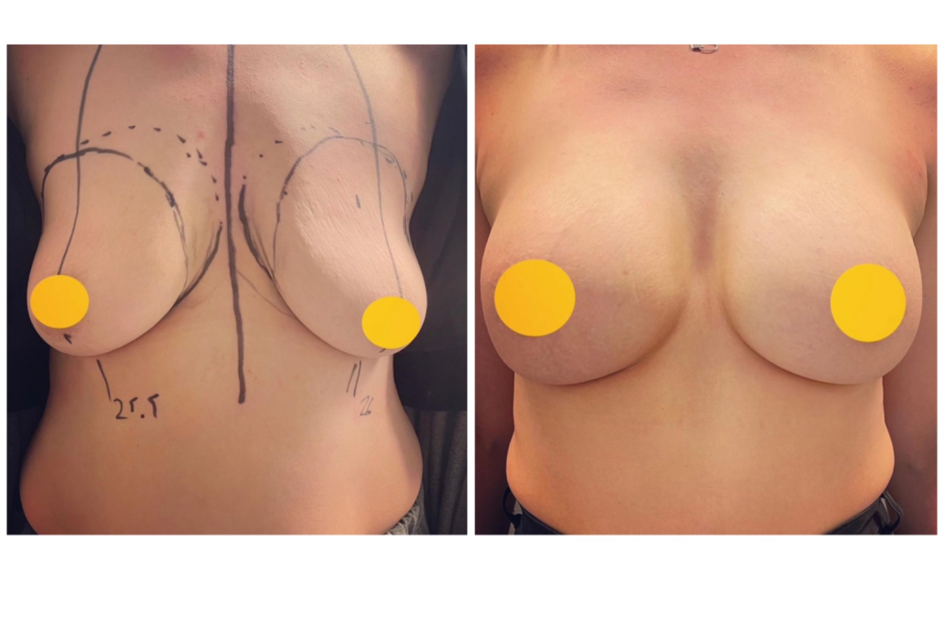 Augmentation with 320cc implants