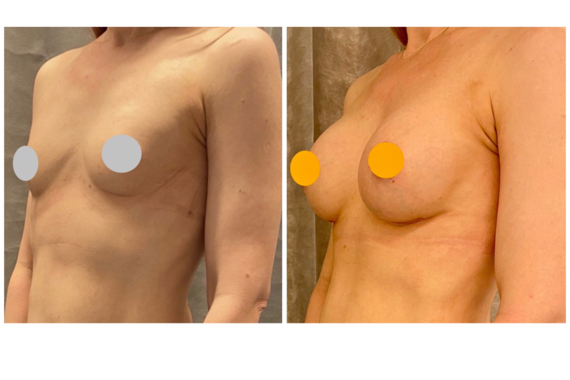 Augmentation with 230cc implants