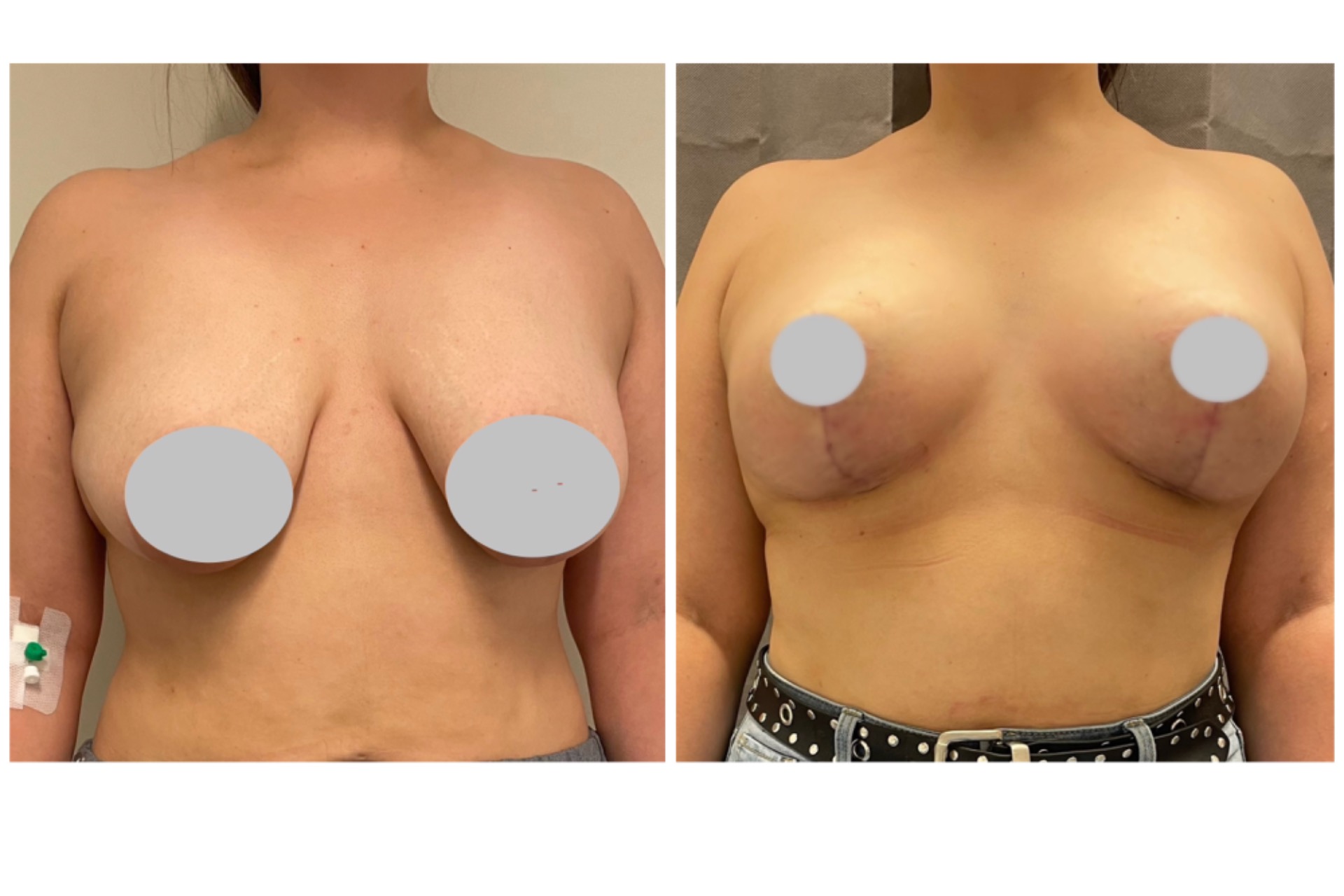 Mastopexy (breast lift)