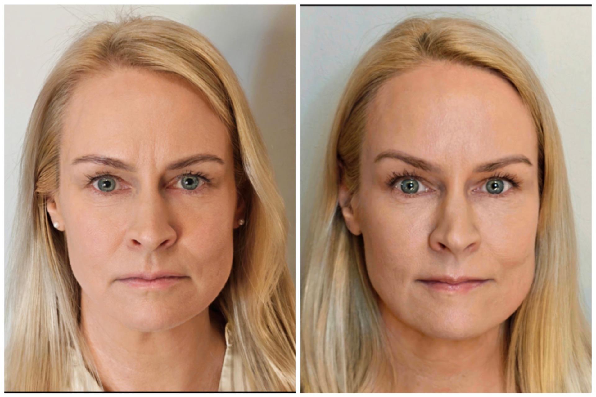 Kasvojen botox ja täyteainehoito