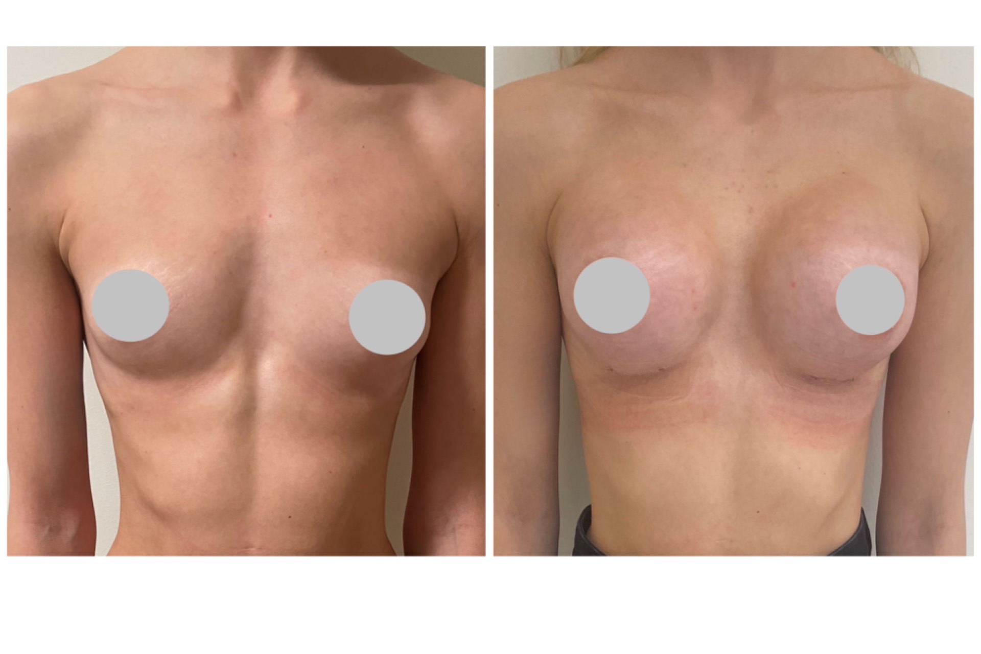 275cc implantit lihaksen alla