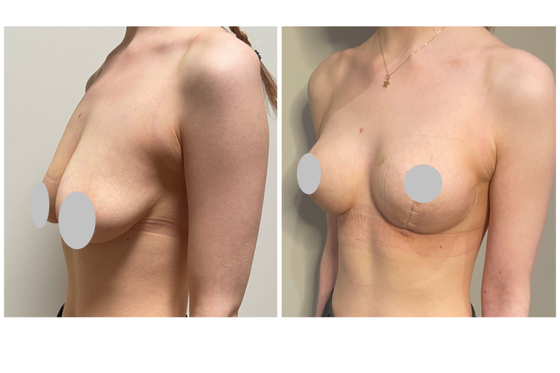 Mastopexy (autoaugmentation)