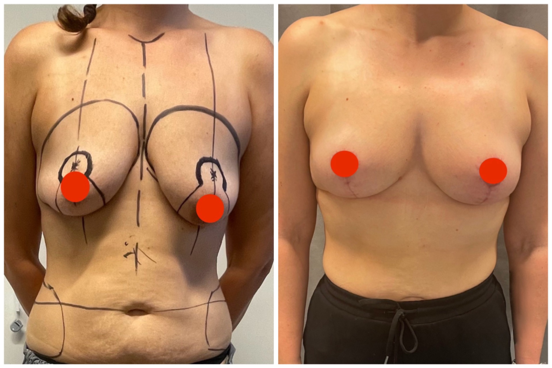 Mastopexy+ fat transfer