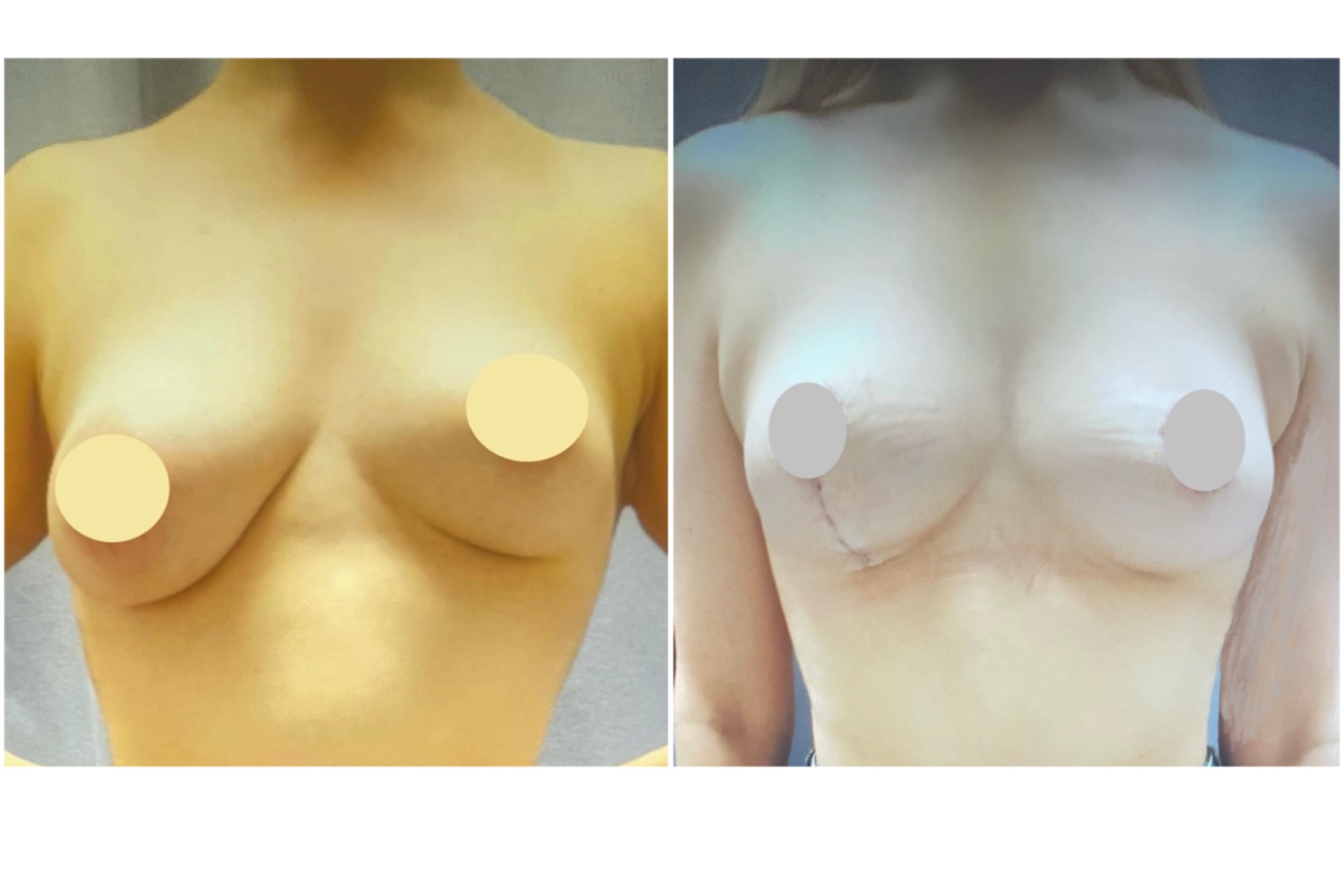 Mastopexy (asymmetric breast correction)