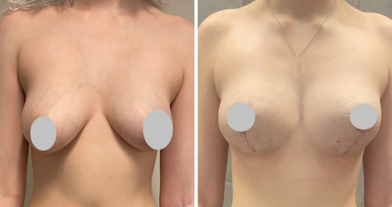 Mastopexy (tubular breast correction)