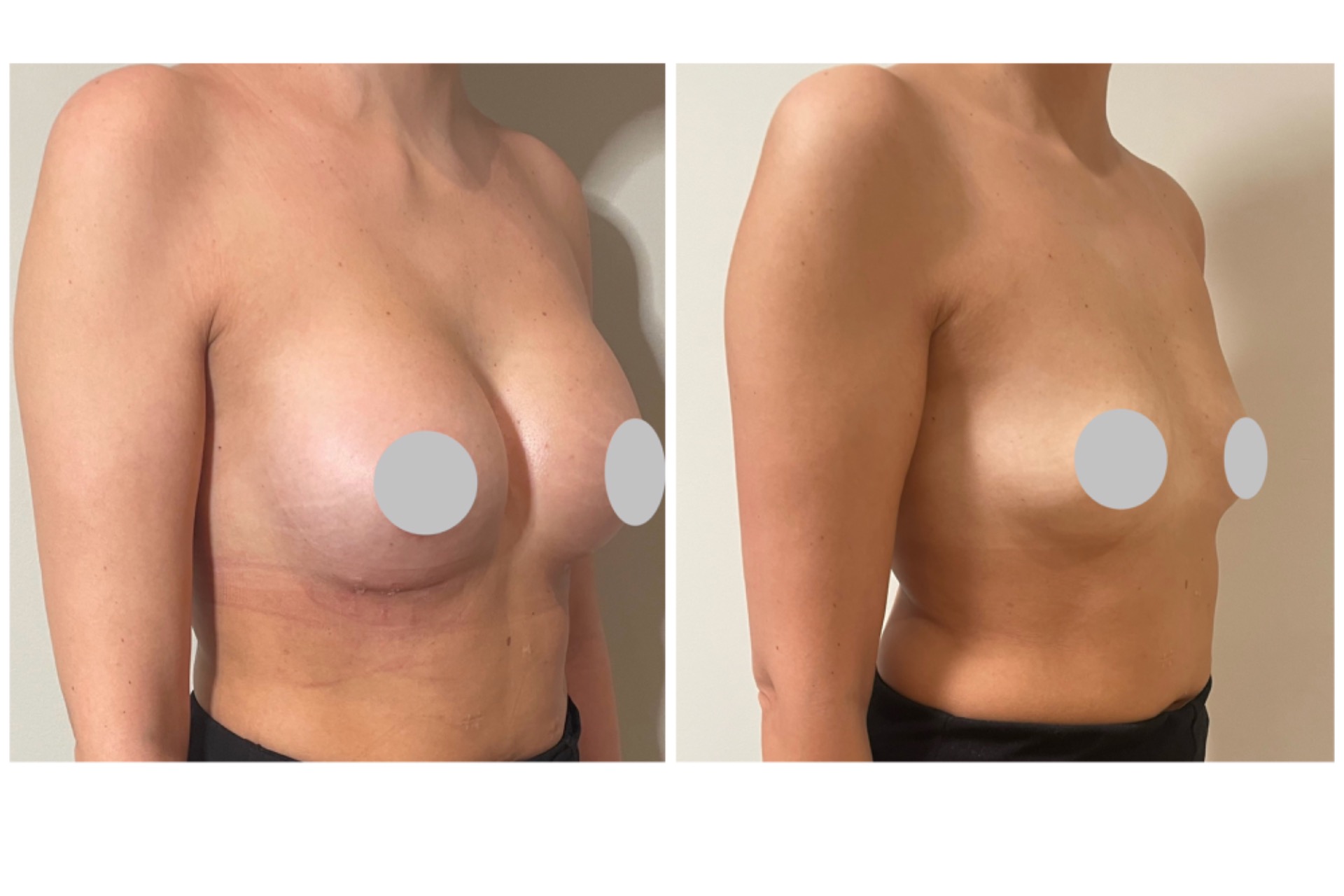 315cc round implants