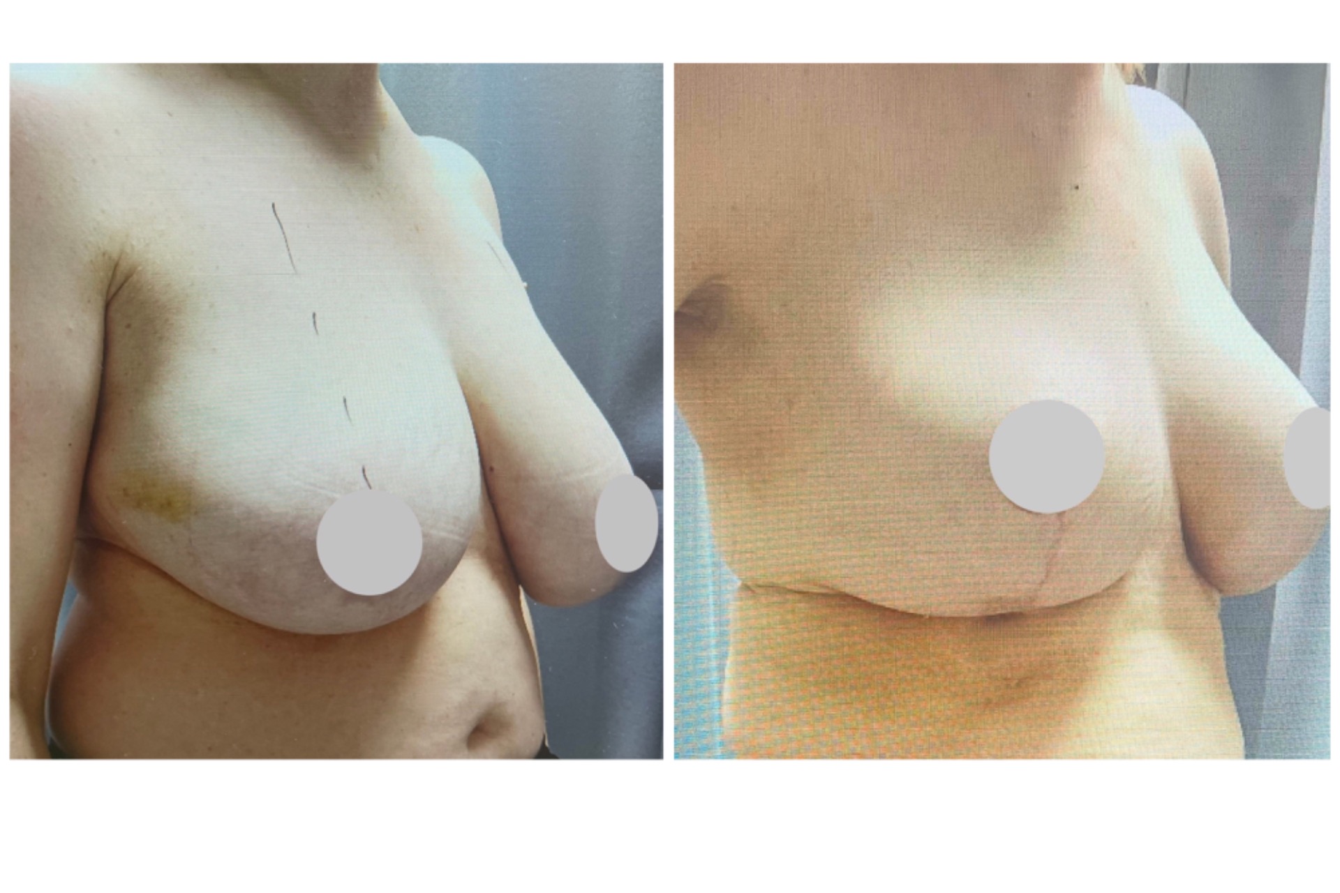 Rintojen pienennys/kohotus