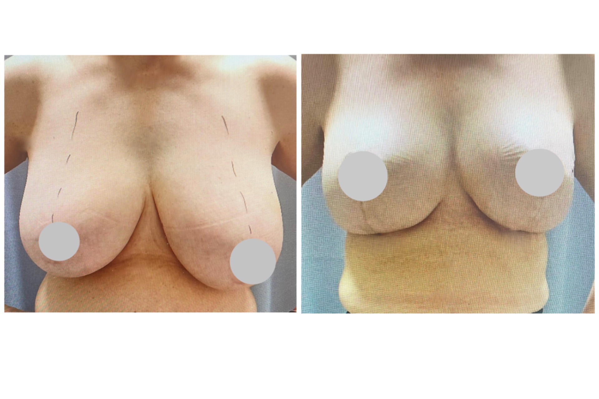 Rintojen pienennys tikkaritekniikalla