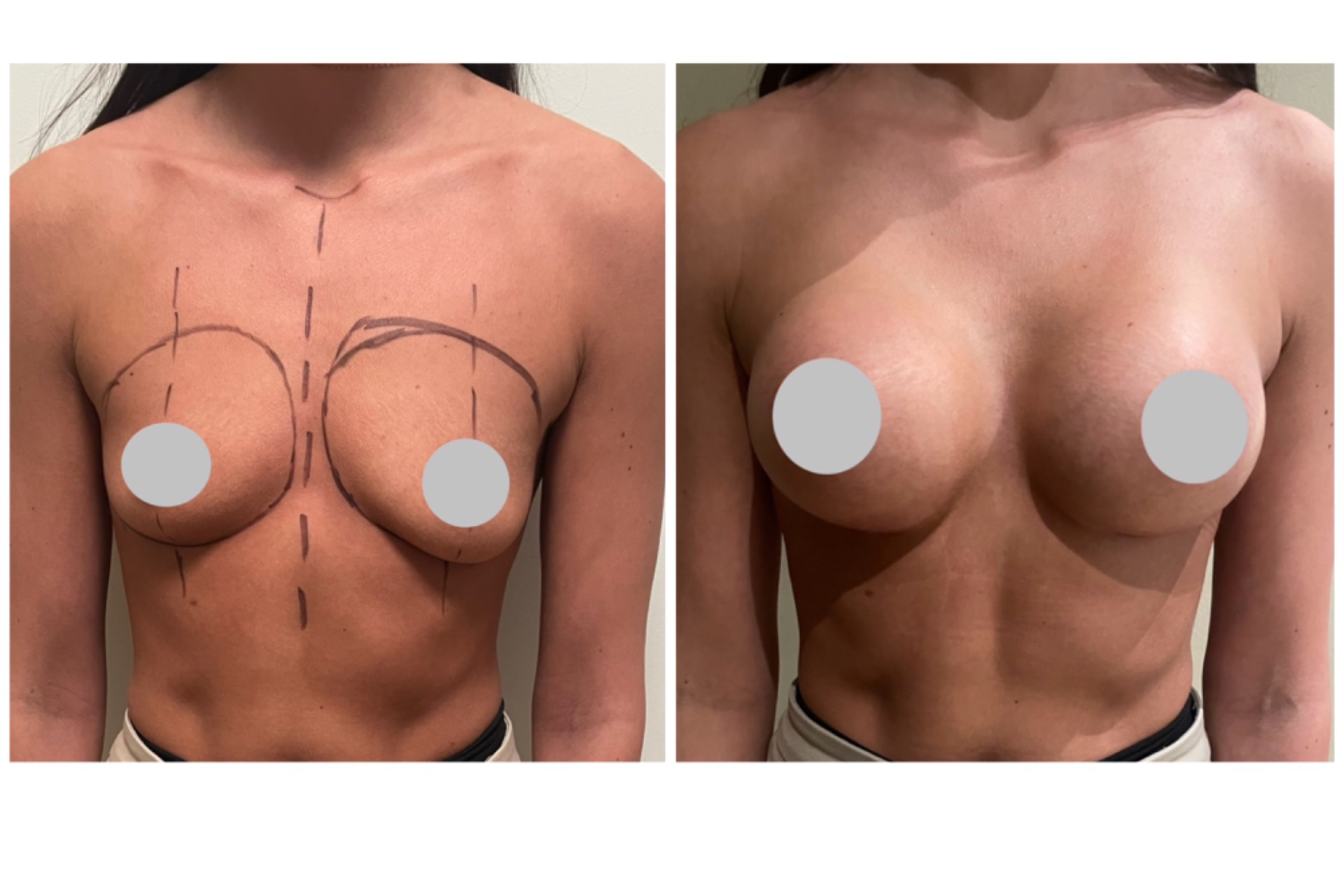 Augmentation 380cc implants
