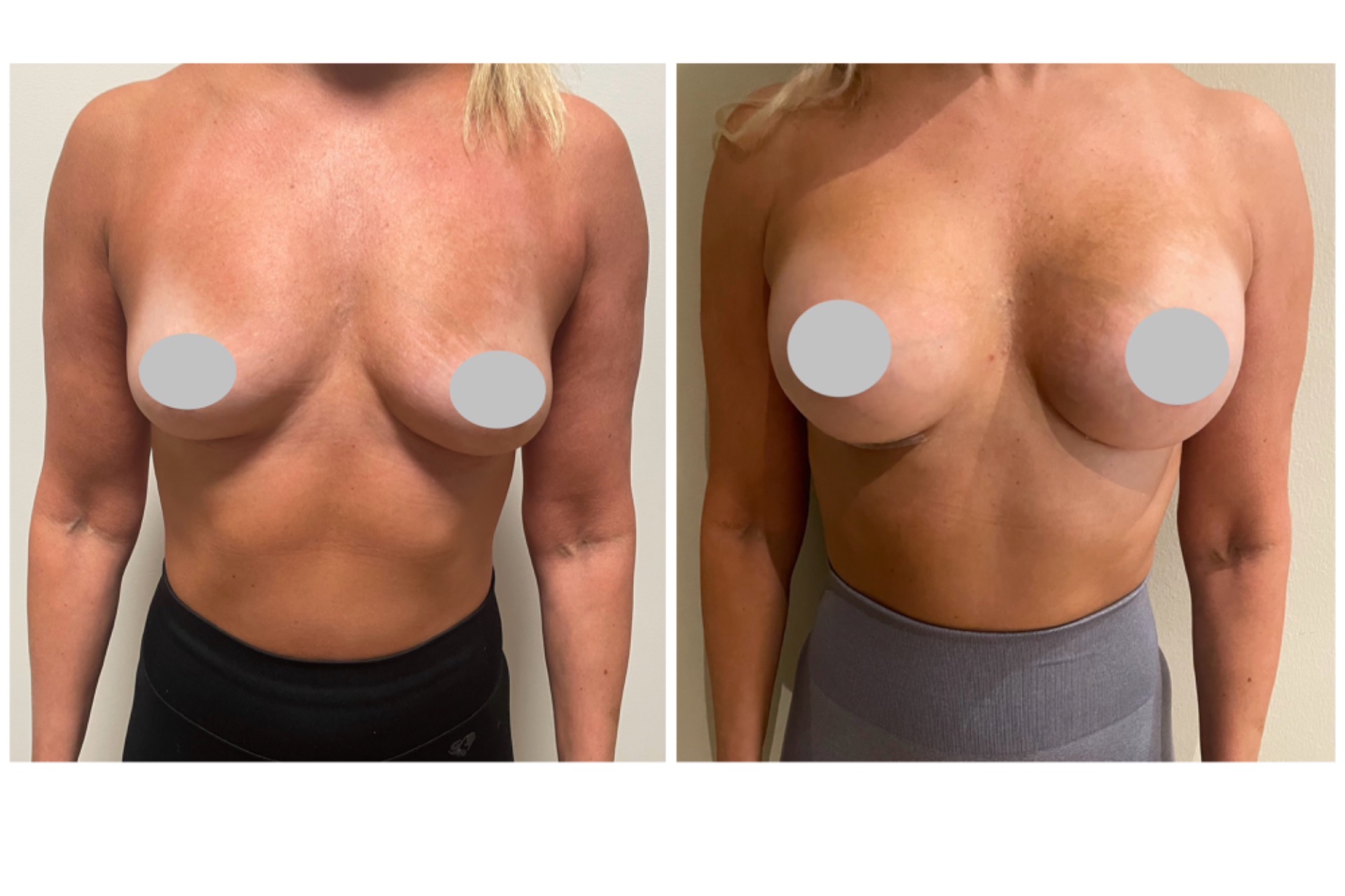 285cc implants