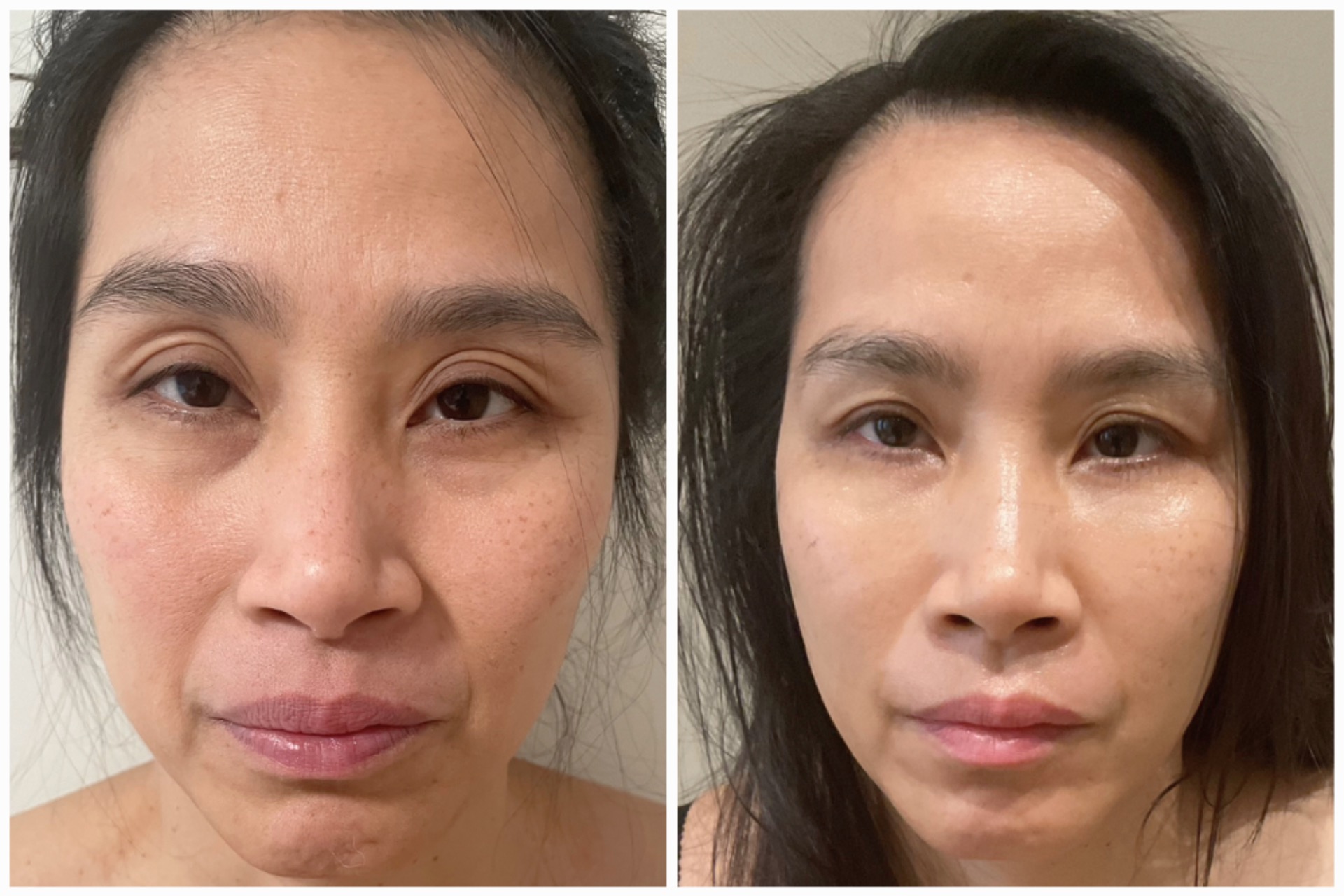 Fat transfer to chin area