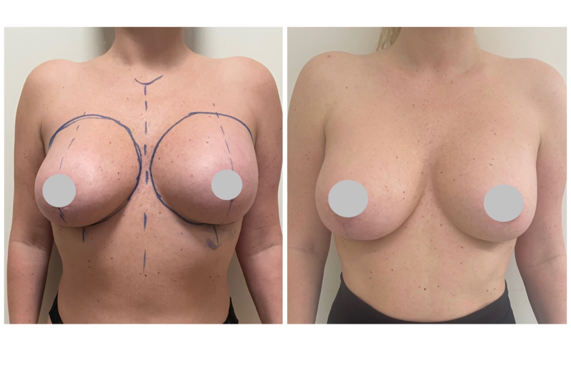 Broken implant exchange and asymmetry correction