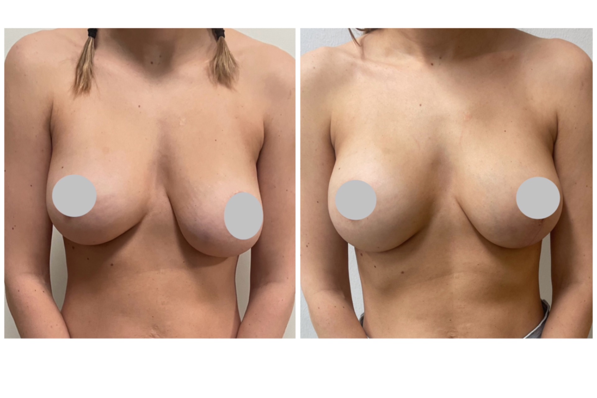 Broken implant exchange and asymmetry correction