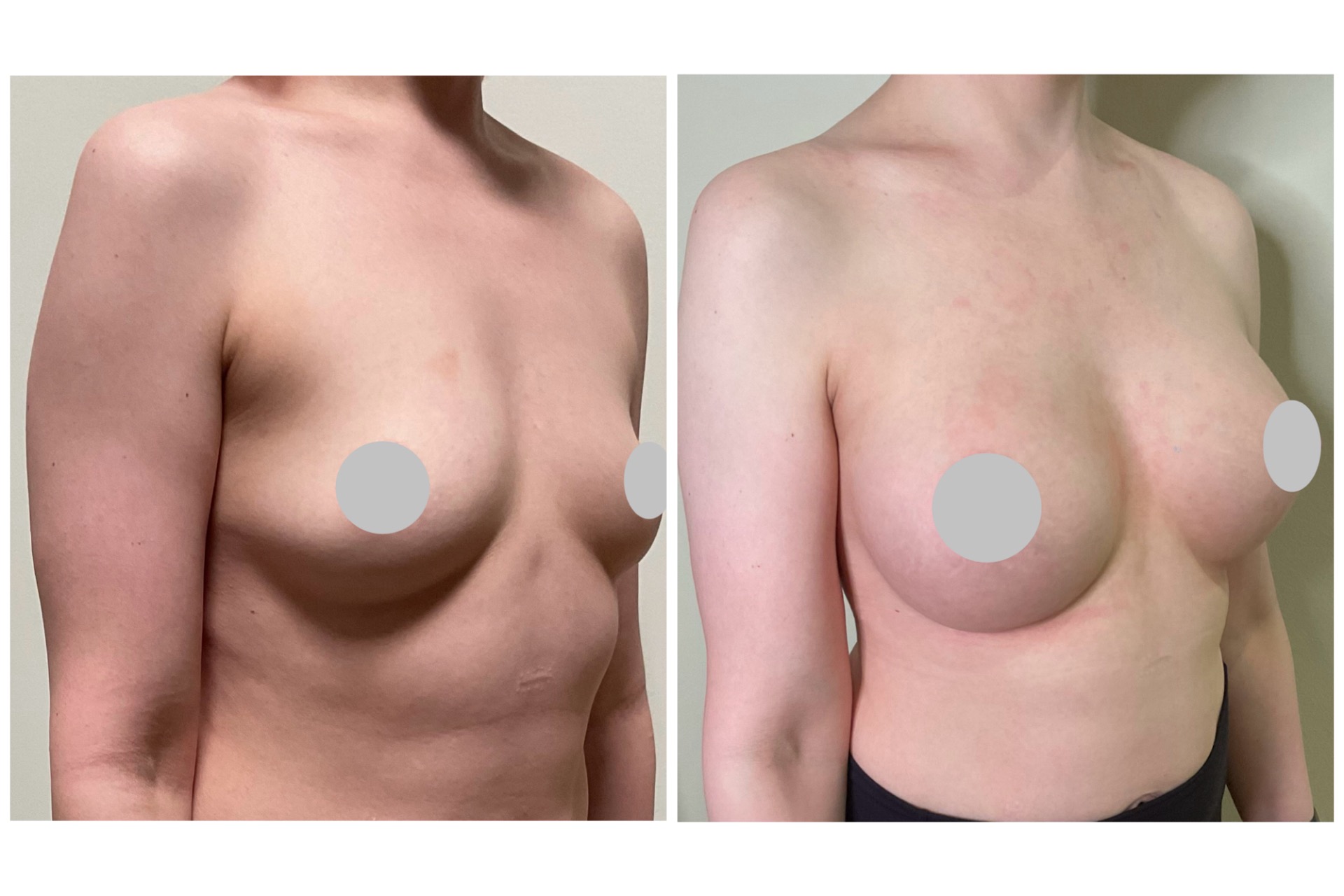 Augmentation 425cc implants