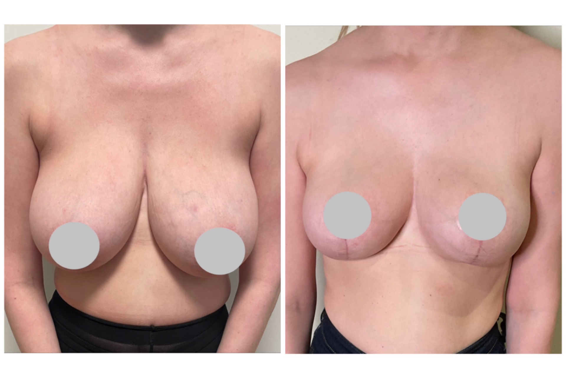 Breast reduction (vertical scar)