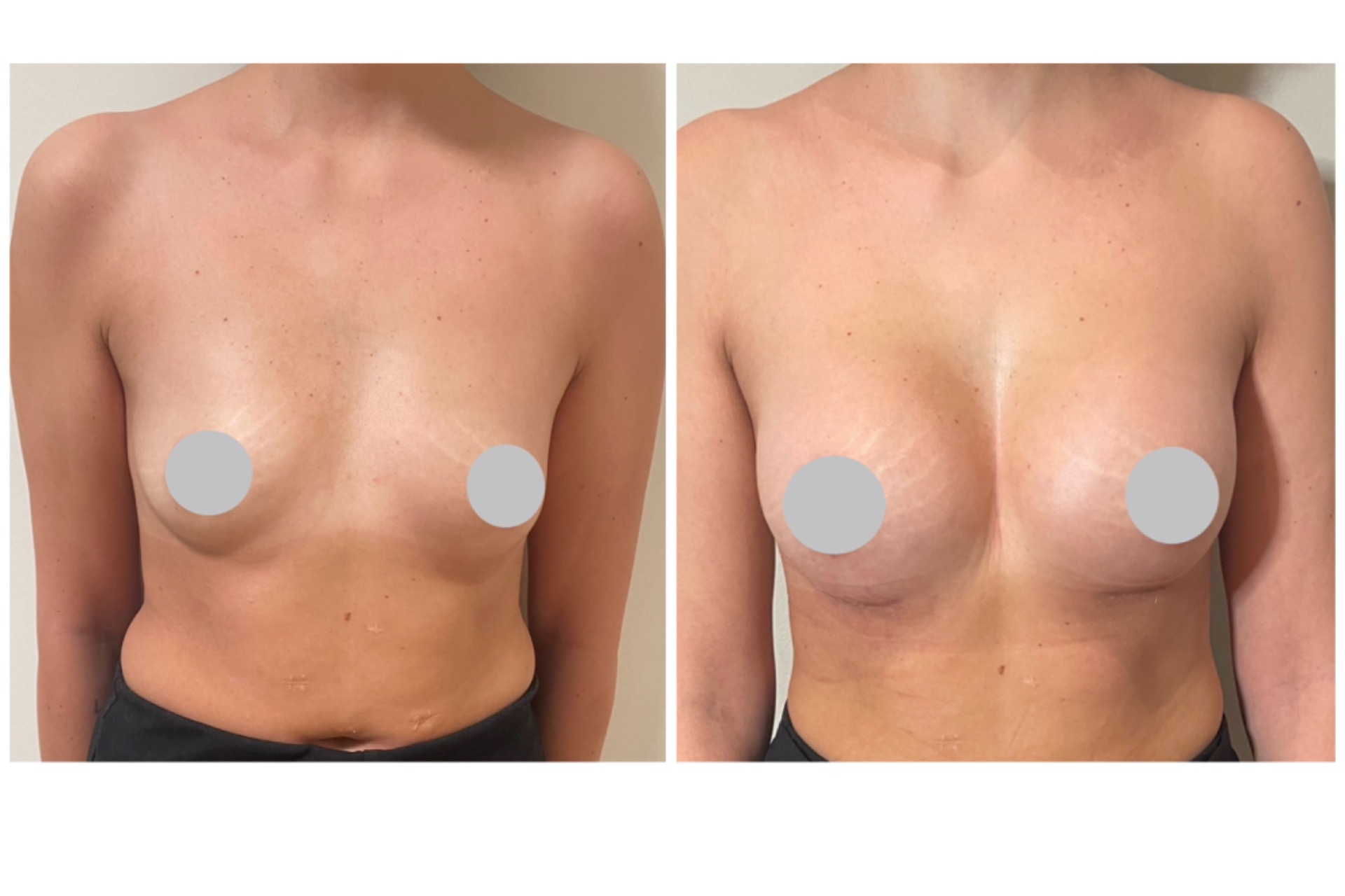 315cc round implants
