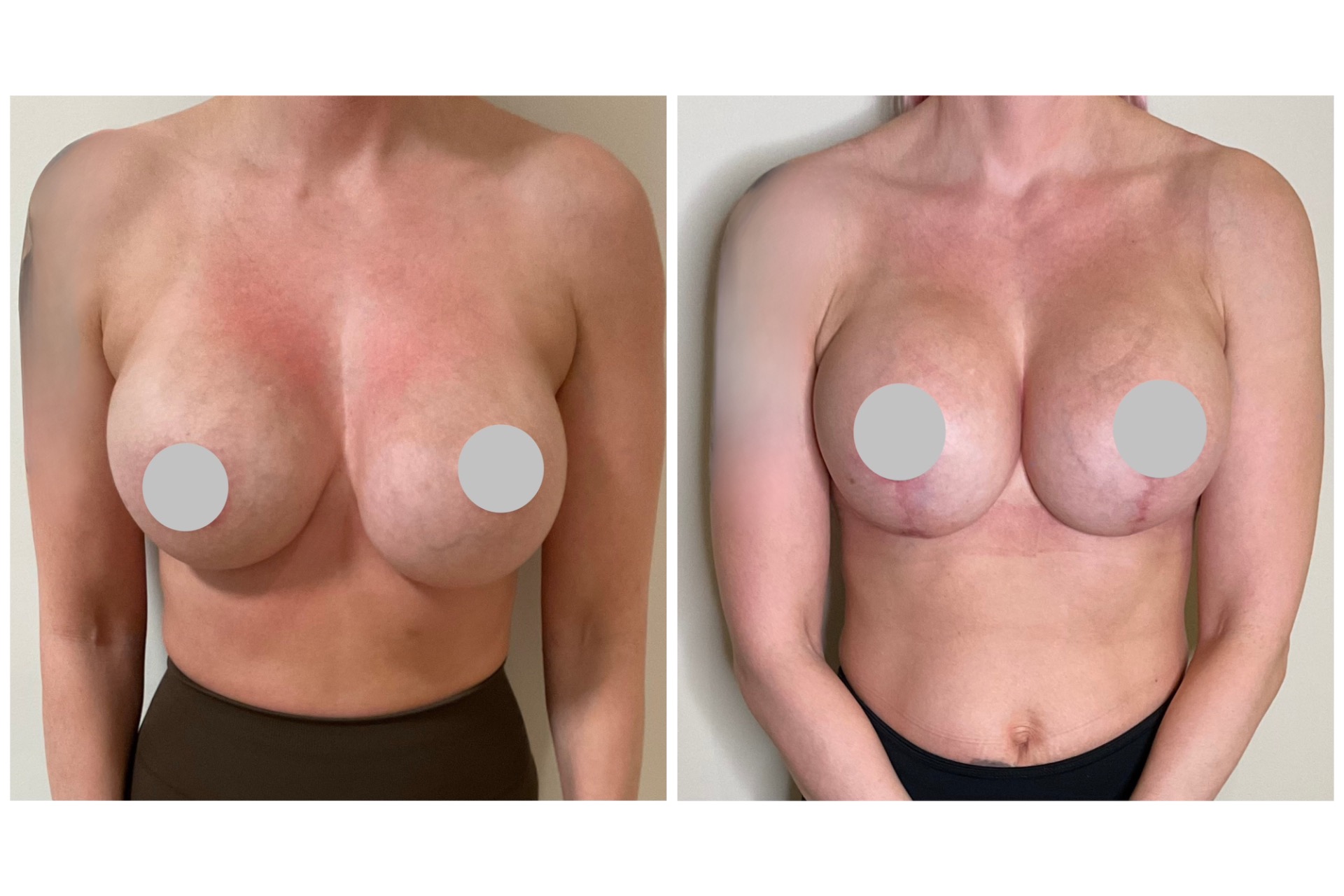 800cc implanttien vaihto 650cc kevytimplantteihin (B-lite)